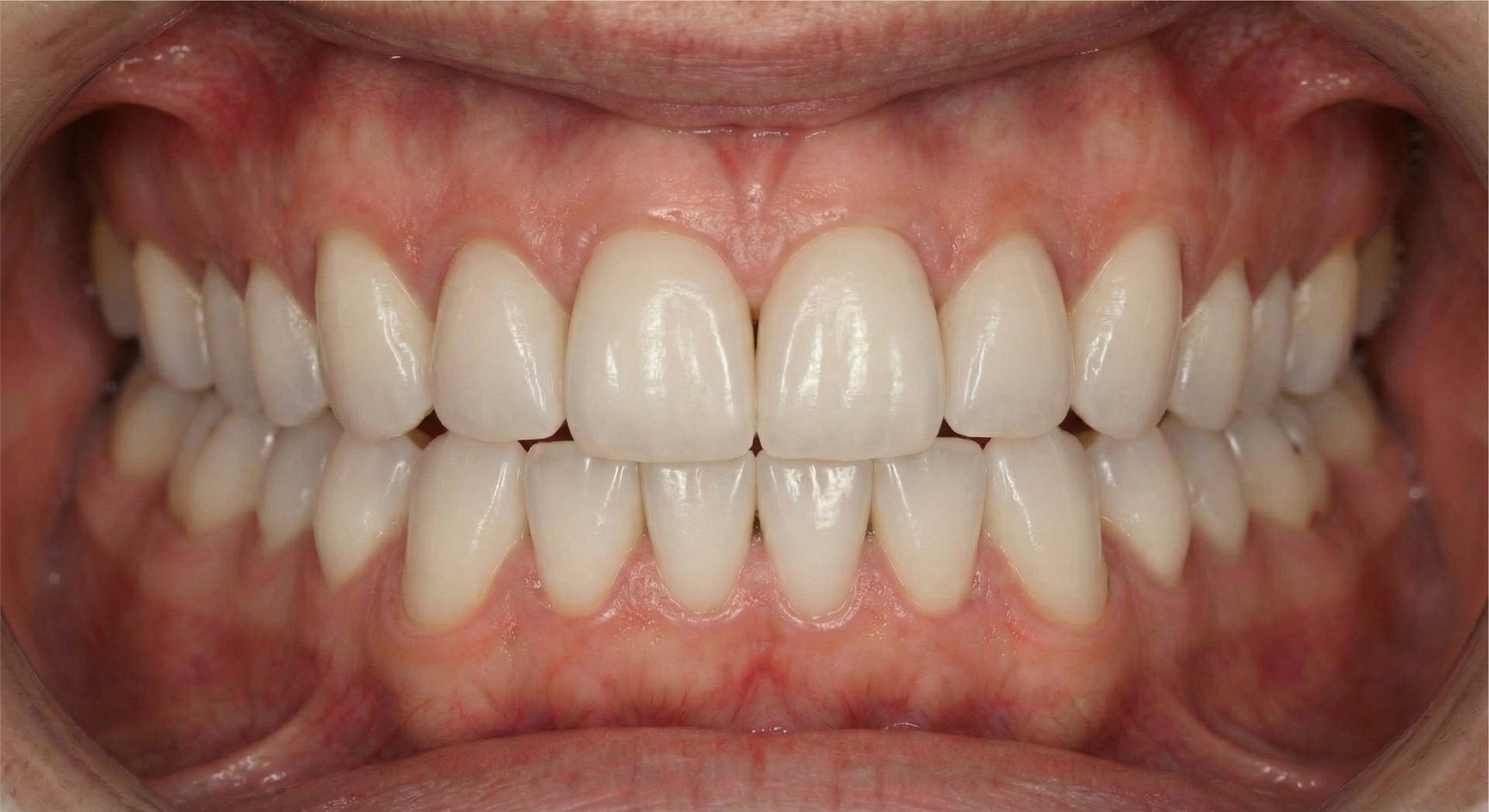 After — Full Mouth Rehabilitation